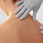 Anti-Dandruff Treatments
